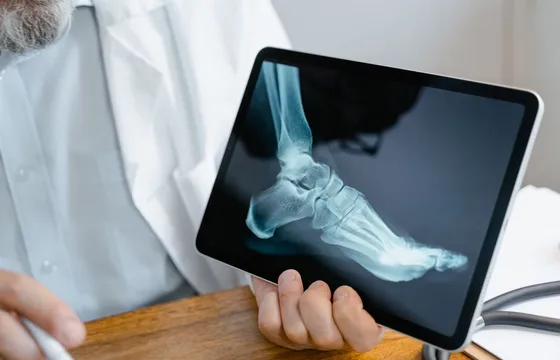 Vue anatomique de l'épine calcanéenne sous l'os du talon, avec le fascia plantaire